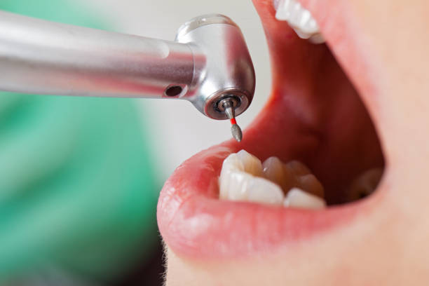 Best Emergency Root Canal Treatment in West Liberty, IA